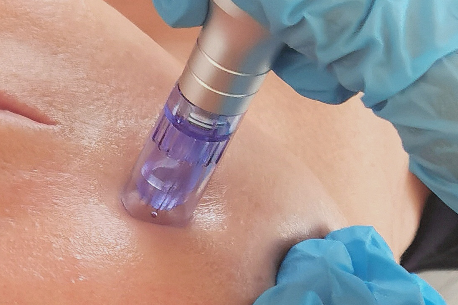 Prodotti_microneedling_slide_home